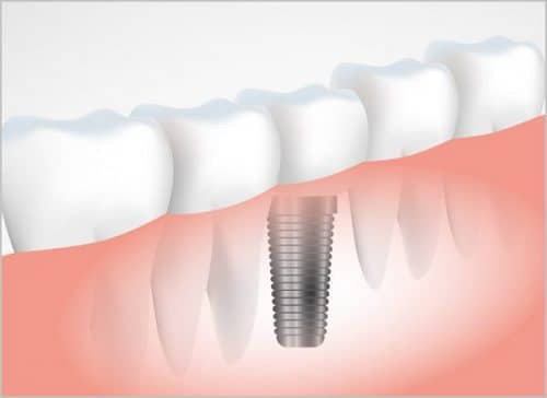 어금니임플란트가격 비교시 주의할 5